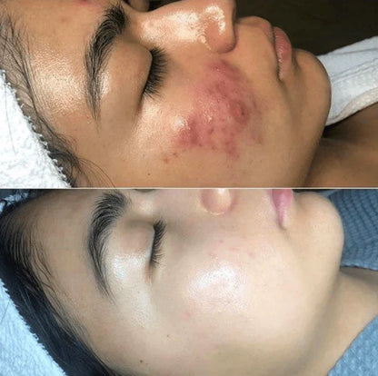 High-Frequency Facial Therapy Wand