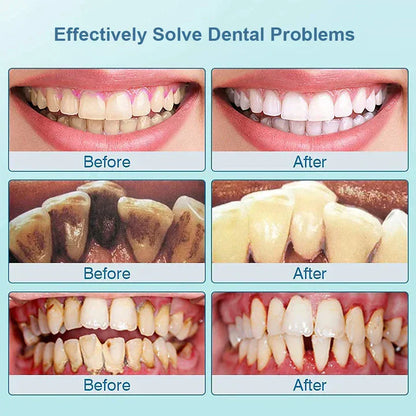 Electric Sonic Plaque Remover | SmileCare Pro